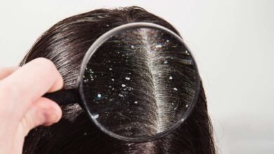 सर्दियों में बढ़ गई है बालों में रूसी की समस्या तो आजमाएं ये उपाय