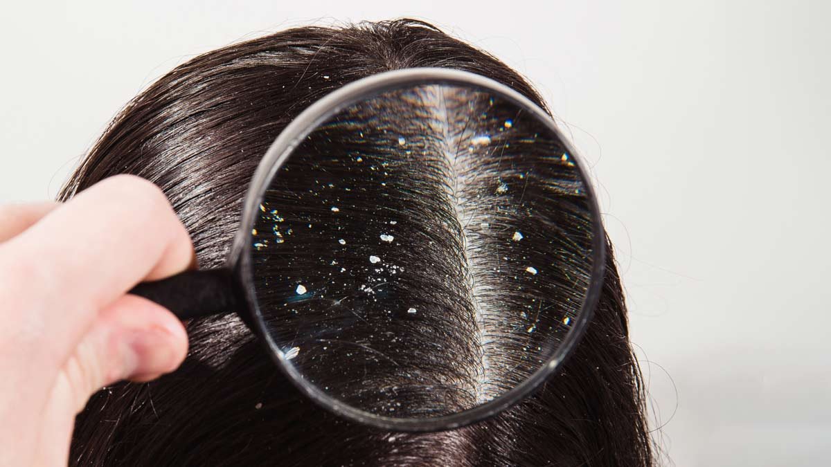 सर्दियों में बढ़ गई है बालों में रूसी की समस्या तो आजमाएं ये उपाय