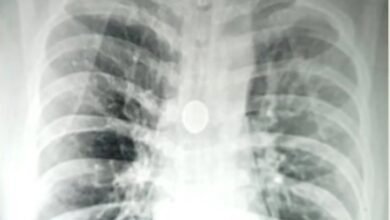 8 साल से सांस की नली में फंसा था 25 पैसे का सिक्का, डॉक्टरों ने 20 मिनट में निकाला