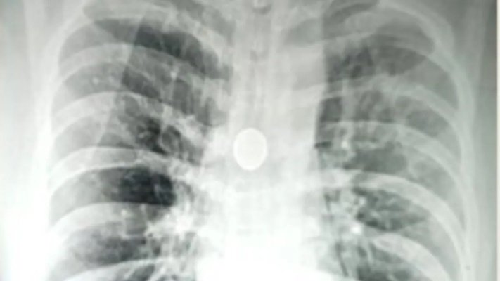 8 साल से सांस की नली में फंसा था 25 पैसे का सिक्का, डॉक्टरों ने 20 मिनट में निकाला